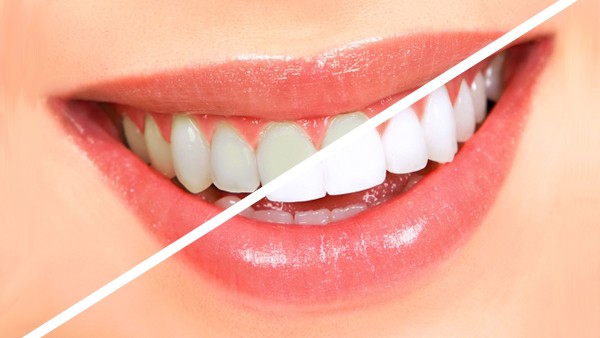 Homeopátiás fogkrémet keresel? Megtaláltad! Ez a fogaidat is fehéríti.
